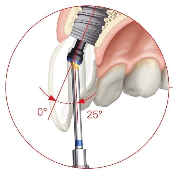 Bei dem ASC Abutment von Nobel Biocare kann der Schraubenkanal in einem Winkel von 0 bis zu 25 Grad zur Implantatachse und innerhalb eines 360 Grad-Radius gesetzt werden