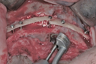 Abb. 5a: Rekonstruktion des Kieferkamms mittels BBA Concept (Biological Bone Augmentation). Palatinal wird eine überstehende Schraube mithilfe der MicroSaw gekürzt.