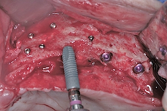 Abb. 7: In den neu aufgebauten Knochen können 6 Astratech Implantate (Dentsply Sirona) inseriert werden.