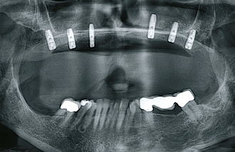 Abb. 8: Das postoperative Röntgenbild zeigt die 6 inserierten Implantate im Oberkiefer.