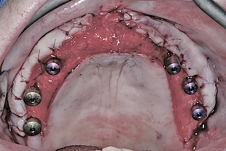 Abb. 11: Situation mit apikalem Verschiebelappen; der palatinale Bereich bleibt der sekundären Wundgranulation überlassen.