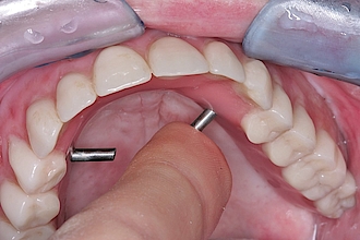 Abb. 26: Die Steg-Riegel-Konstruktion erlaubt eine feste Fixierung der Prothese, was der Patientin viel Sicherheit und das Gefühl fester Zähne gibt.