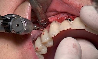 Abb. 2: Insertion von sechs Implantaten.
