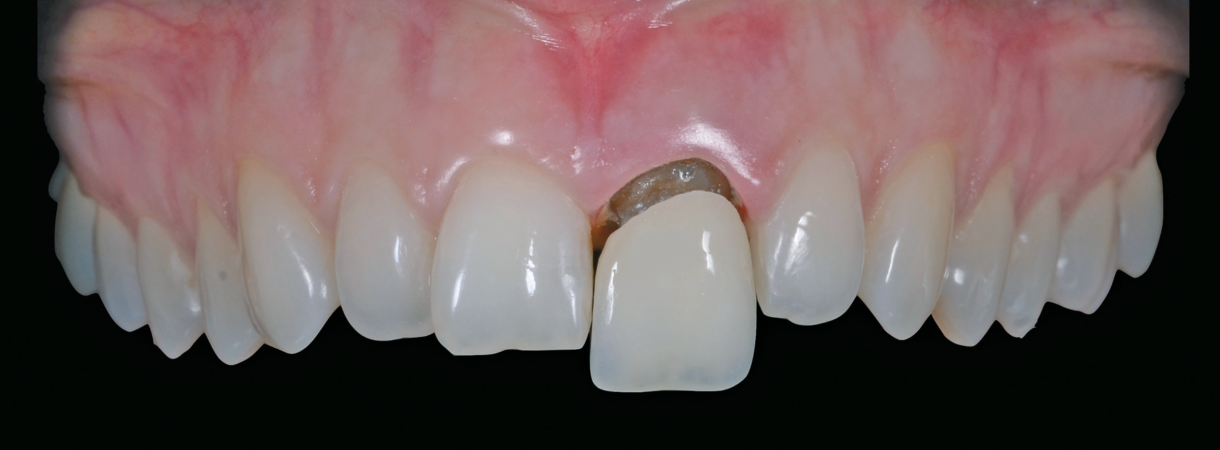 Grau sich zahn verfärbt ω Zahn