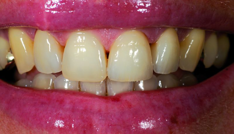 A1 bilder zahnfarbe Zahnfarben